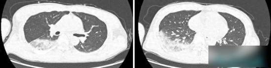 主人把鹦鹉放在口袋里饲养15天后感染鹦鹉热，肝肾功能都出现了损伤