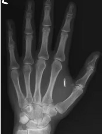 太有赛博朋克那味儿了！魔术师手上植入芯片后，居然把密码给忘了