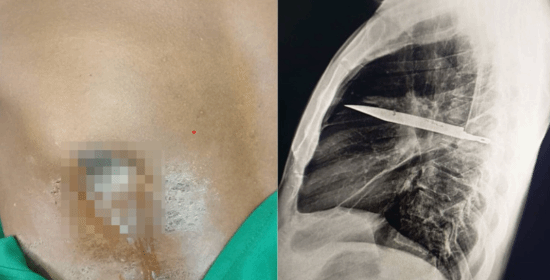 男子胸部流脓就医，X光检查竟发现体内遗留刀具达8年之久，且刀具位置恰好避开心脏与血管