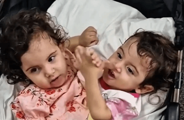 巴西一对连体双胞胎在接受分离手术后，最终相继离世