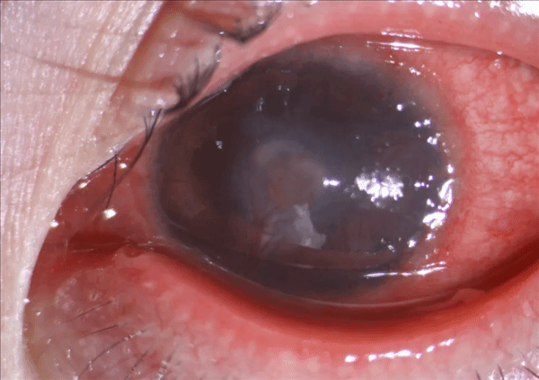 患流感5天未取下隐形眼镜，镜片近乎融化，医生警示：或致永久性视力损伤